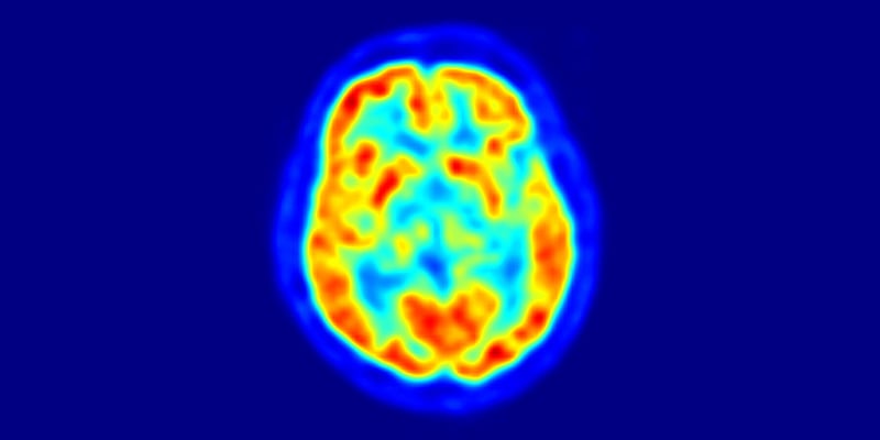 This is a transaxial slice of the brain of a 56 year old patient (male) taken with positron emission tomography (PET) / Image © Jens Maus, Public Domain