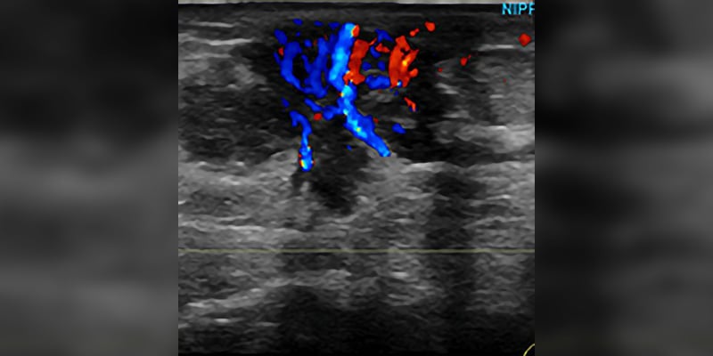 Breast Imaging Essentials: Module 9 - Breast Ultrasound